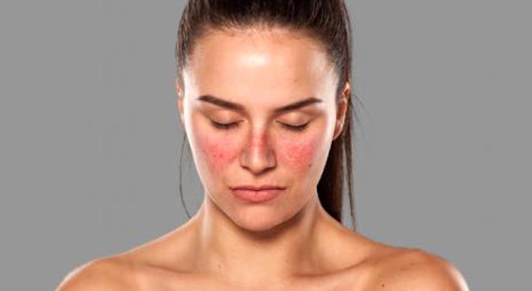 alimentacion-personas-con-lupus